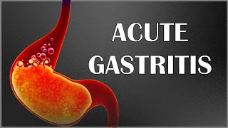 Acute Gastritis - Signs & Symptoms, Causes, Pathogenesis, Complications, Diagnosis & Treatment