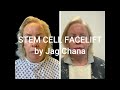 Plastic Surgery London - Stem Cell Facelift Surgery