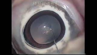 第3回ophthalmic surgery film award 2008 Gold award受賞動画【浅見眼科手術クリニック】