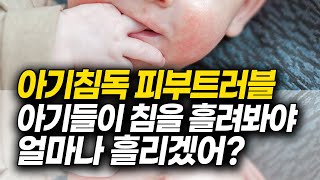 아기 피부트러블! 침독 관리 성공 해결방법 4가지!