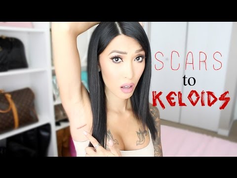 Breast Augmentation Scars Turns Into Keloids Breast Augmentation Scars Turns Into Keloids