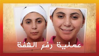 Lip lifting by Dr. Maen Alkhateeb