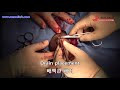 reduction of penile fat augmentation revision 자가지방 음경확대 축소수술