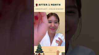 BANOBAGI Real Model: Rhinoplasty + Eyelid surgery!