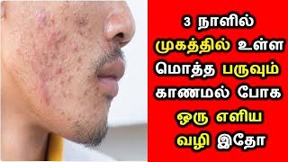 ஆண்கள் முகத்தில் உள்ள பருக்களை 3 நாளில் நீக்க எளிய வழி|Mens Pimple removing Easy Tips