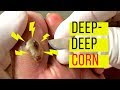 GIANT! Deep-Deep Corn Removal!