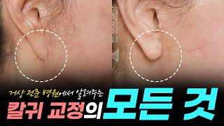 👨‍⚕️칼 귀, 도대체 어떻게 교정하냐구요? #칼귀교정 #VY피판술 #칼귀