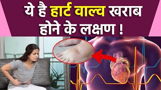 हार्ट के वाल्व खराब होने के लक्षण | Heart Valve Disease Symptoms | Boldsky