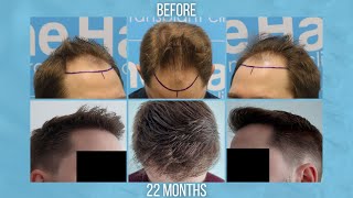 Frontal Zone FUE Hair Transplant by Dr Arshad (3504 grafts across two sessions)