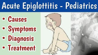 Acute Epiglottitis In Children Causes, Clinical features, Diagnosis and Management