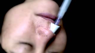 Using Nasal Naloxone to Reverse Opiate Overdose