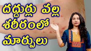 దద్దుర్లు వల్ల శరీరం లో మార్పులు Changes in the body due to Urticaria Hives or wheals | హోమియోపతి