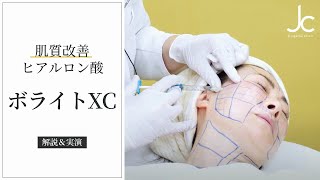 【肌質改善】ヒアルロン酸製剤『ジュビダームビスタ®︎ボライトXC』を解説【注入動画あり】