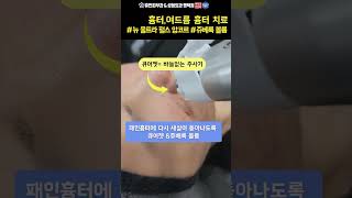 여드름흉터 치료 뉴 울트라 펄스 앙코르