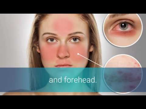 Rosacea Around Nose Rosacea Around Nose