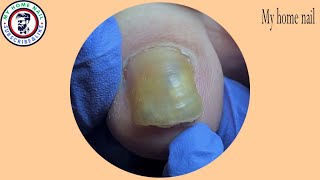 Watch This Toenail Transformation!