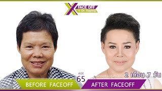 รีวิวดึงหน้า นักธุรกิจวัย 65 ฝังใจกับแผลเป็น ท้อใจไม่อยากทำหน้าอีก เฟซออฟสานต่อความสวยอีกครั้ง