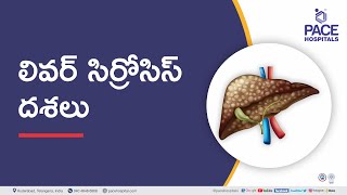 Liver Cirrhosis Stages in Telugu - లివర్ సిర్రోసిస్ అంటే ఏమిటి? | Cirrhosis of the Liver Stages