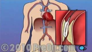 Balloon Angioplasty Coronary Angioplasty Heart Surgery PreOp® Patient Education