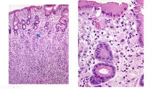 GI/Liver Pathology Diagnoses That You Don't Want to Miss by Rondell P. Graham, MBBS