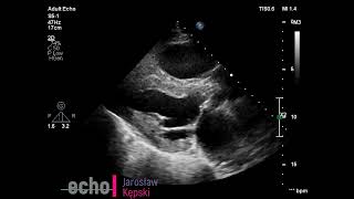 Mitral Aortic Tricuspid Regurgitation, niedomykalność mitralna aortalna trójdzielna, zastawki serca