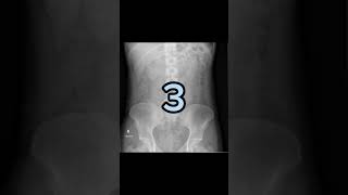 what is your diagnosis?#abdominal xrays case 48#trending #youtube #shortvideo #viral #shorts#short