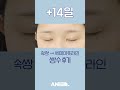 속쌍 → 세미아웃라인｜쌍수 후 눈변화과정｜ 2주로 보는 절개 쌍수 후기 #shorts #쇼츠