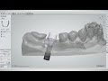 CAD/CAM Tools, Tips and Tricks: Custom Abutment Design (Vol. 1, Issue 2)