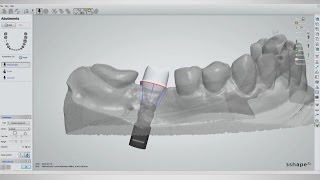 CAD/CAM Tools, Tips and Tricks: Custom Abutment Design (Vol. 1, Issue 2)