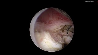 Hysteroscopic Fibroid Polyp Resection (with voiceover)