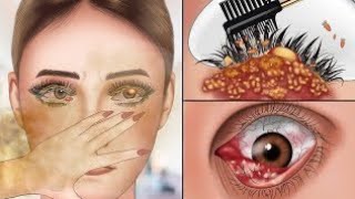 ASMR Remove infected eyes due dirty smoke animation | Lash deep cleaning