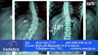 Onurğa əyilmələrinin(skolioz, kifoz) əməliyyatsız və dərmansız müalicəsi!
