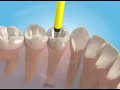 root canal treatment animation 3d premolar