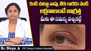 కన్ను నీరు కారుతుందా? || Symptoms and Treatment of Dacryocystitis in Telugu || Sankhya Hospitals