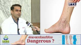 ਕੀ Varicose Veins ਹੋ ਸਕਦੀਆਂ ਨੇ ਤੁਹਾਡੇ ਸ਼ਰੀਰ ਲਈ ਖ਼ਤਰਨਾਕ ?