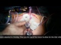 tips of the laparoscopy enhanced hipec technique