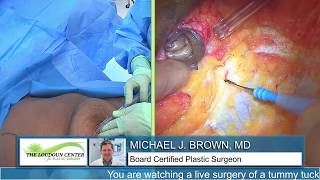 Tummy Tuck with Muscle Sewing: Live Streaming Plastic Surgery by Dr Michael J. Brown