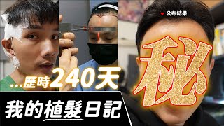 【植髮日記】揭開生髮的秘密｜240天血淚過程 心得全紀錄！feat.髮拉儷植髮蔡醫師