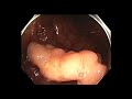 Colonoscopy: Ascending Colon Polyp Resection 1 (for Zoom Class 9/27/2020)