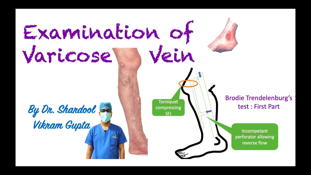 Examination Of Varicose Vein For MBBS/ MS Surgery Medical Students ...