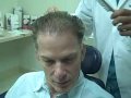 Plastic Surgeon, Dr Jeffrey Epstein,  FUE hair transplant method