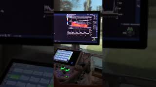 CAROTID PROTOCOL