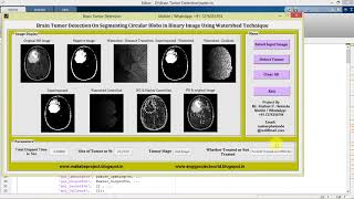 Brain Tumor Detection Using Watershed Technique Matlab Project with Source Code