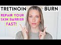 5 MUST HAVE SKINCARE PRODUCTS TO CALM TRETINOIN IRRITATION/ RETINOL BURN FAST!