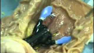 Complete Endoscopic Closure of Gastrotomy Following Natural Orifice Translumenal Endoscopic Surgery