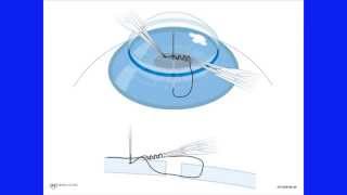 Corneal Suturing, Part 5 - Suturing the Wound