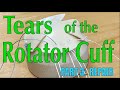 Tears of the Rotator Cuff Part 3: Suture Anchor Repair of the Rotator Cuff