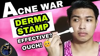 DERMASTAMP IS BETTER THAN DERMAROLLER | DRS Derma Stamp 140A