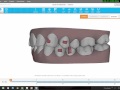 Invisalign Tips to solve a Deepbite and a Class II malocclusion