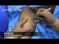 Arm Lift and Liposuction ( Brachioplasty ) - Chennai Plastic Surgery , India